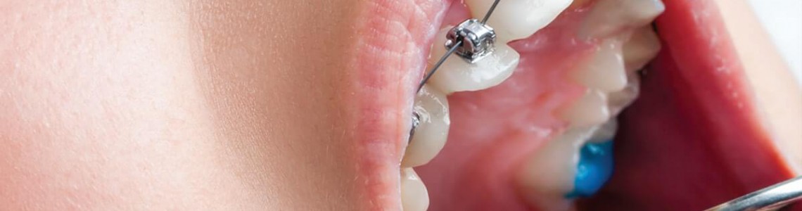 آمالگام دندان چیست؟ مزایا و معایب آمالگام